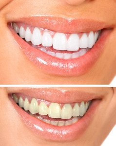 How Teeth Whitening Works