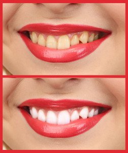 Is Teeth Whitening Worth It?