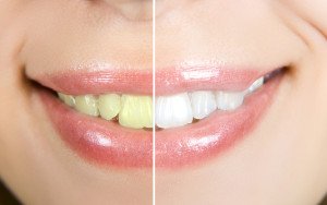 What To Know About OTC Teeth Whitening Gels