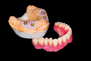 Making The Decision Between Dentures And Dental Implants