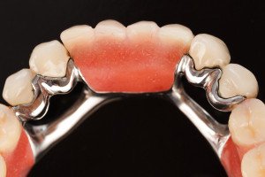 6 Common FAQ’s Regarding Dental Bridges