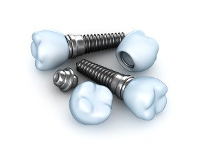 6 Primary Benefits Of Dental Implants