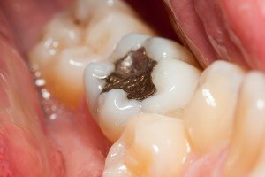 A Brief Overview Of The Different Types Of Fillings