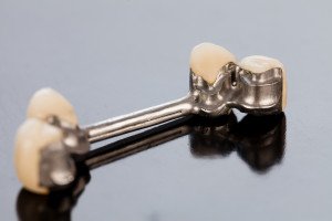 Are Dental Crowns The Right Choice For You?