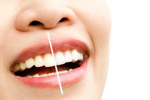 Exploring The Different Tooth Whitening Options