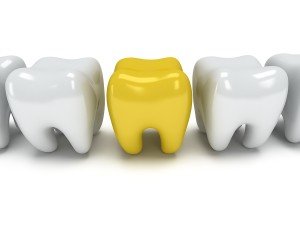 How To Know If You Are A Candidate For Dental Bonding