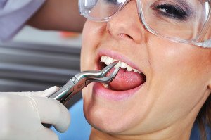 Primary Reasons For Tooth Extractions