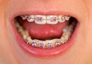What Types Of Braces Are Available?