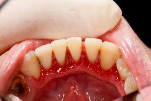 Periodontal Disease:  Symptoms And Treatment