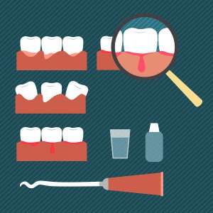Periodontal Disease:  Understanding The Difference Between Gingivitis And Periodontitis