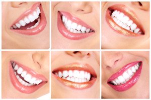 Important Facts About Teeth Whitening For You To Know
