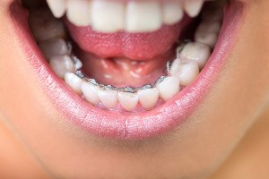 Comparing The Different Types Of Braces