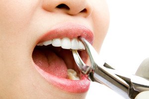 Time To Extract A Tooth? These Are The Telltale Signs