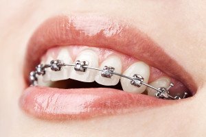 How To Tell If You’re A Candidate For Getting Braces