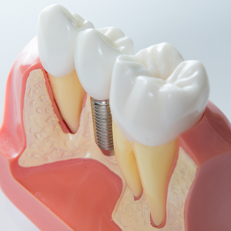 Why Do Dental Implants Sometimes Fail Community Dental Group