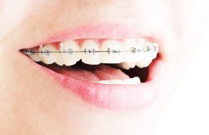 Braces Options And How They Work