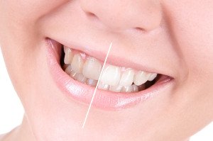 The Truth About Tooth Whitening