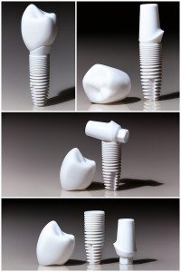 The Incredible Effects Of Dental Implants