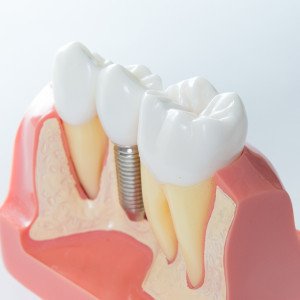 Dental Implants Are Expensive, But Often Worth The Price