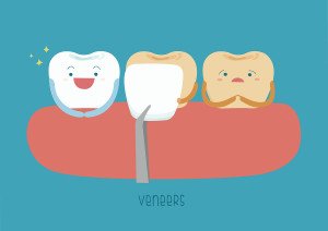 Why Should You Try Dental Bonding?
