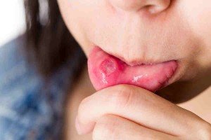 Tongue And Cheek: A Canker Sore Story