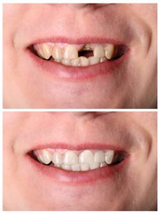 Cosmetic Dentistry: It's Not Just For Looks 