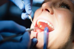 Cavity Fillings Are An Ounce Of Prevention