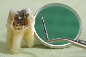 Tooth Extractions – What You Need To Know