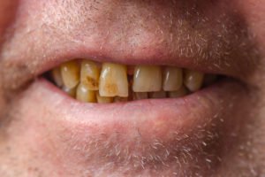 3 Ways To Stain Your Teeth